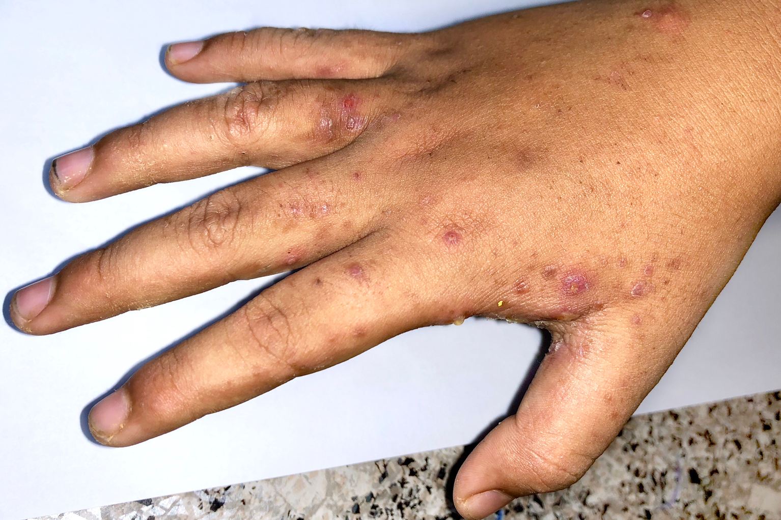 Rash on medium brown skinned hand, red spots and smaller brown darks spots over knuckles and in between fingers