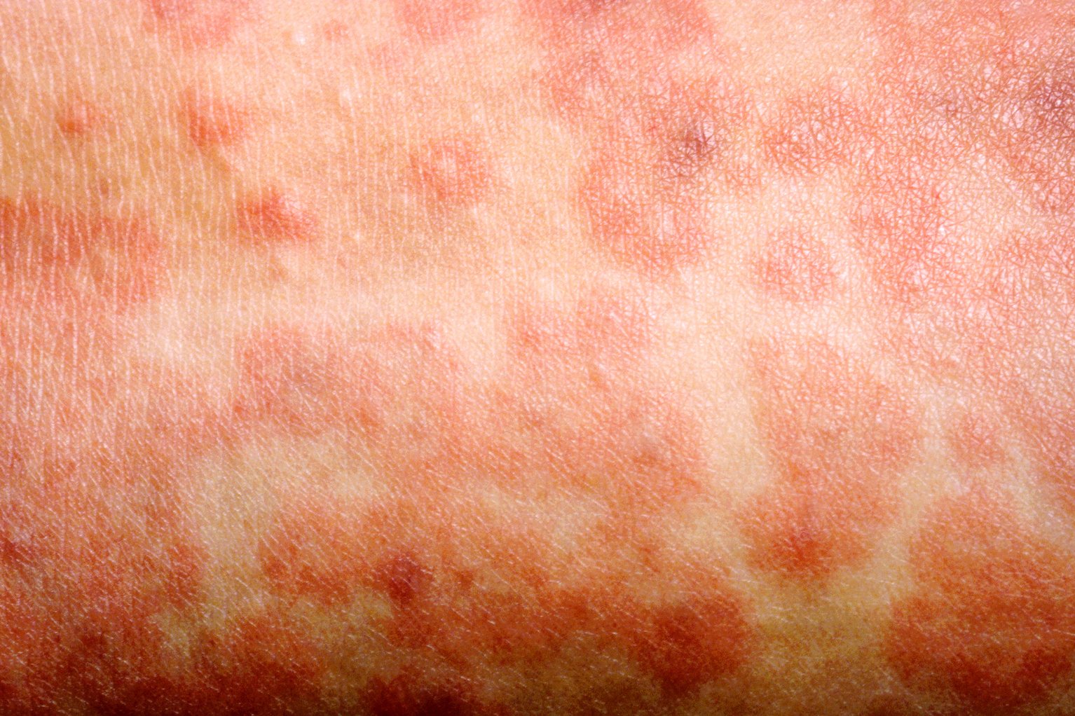 close up photo of the red blotchy rash with small raised dots forming blotchy patches.