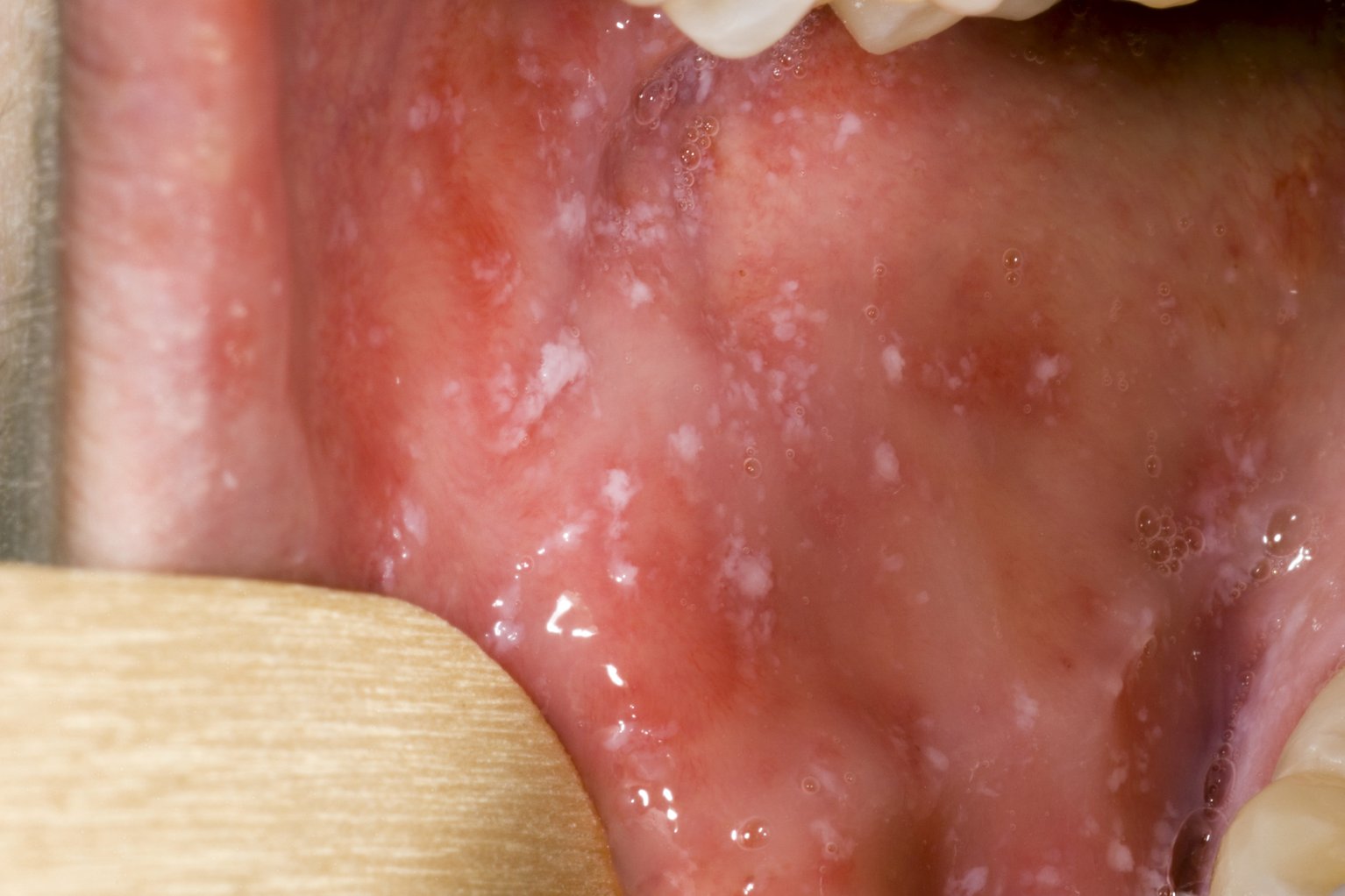 inside of a child's mouth, small white patches dotted around the inside of their cheek.