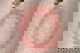 Circular pink rash on light skin around 2cm in diameter. Red ring with a pale centre.