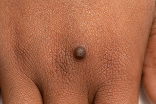 Picture of a wart on medium brown skin. Dark Brown smooth raised bump on knuckle of hand, around 5mm in size.