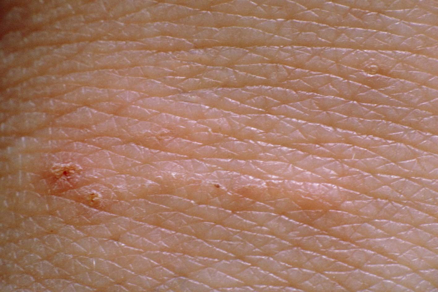 Close up of light skin, tiny red scab followed by a small track of raised bumps.