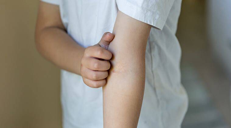 Photograph of a light skinned child wearing a white t-shirt scratching their inner elbow