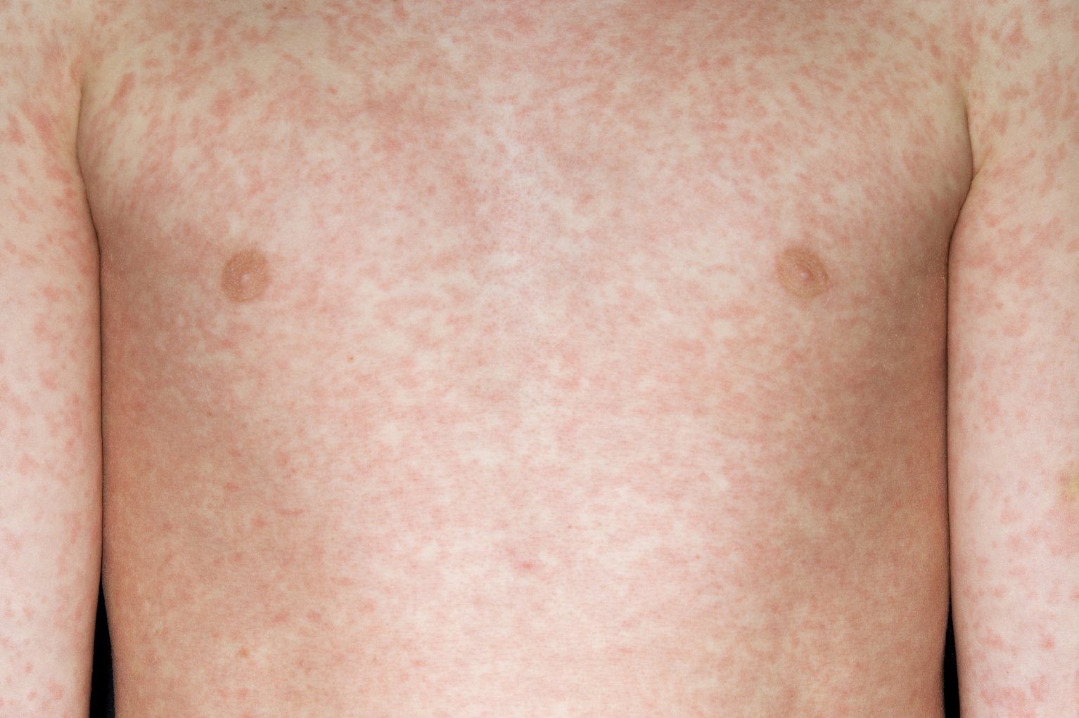 small red dotted rash covering the entire torso of a child with light skin.