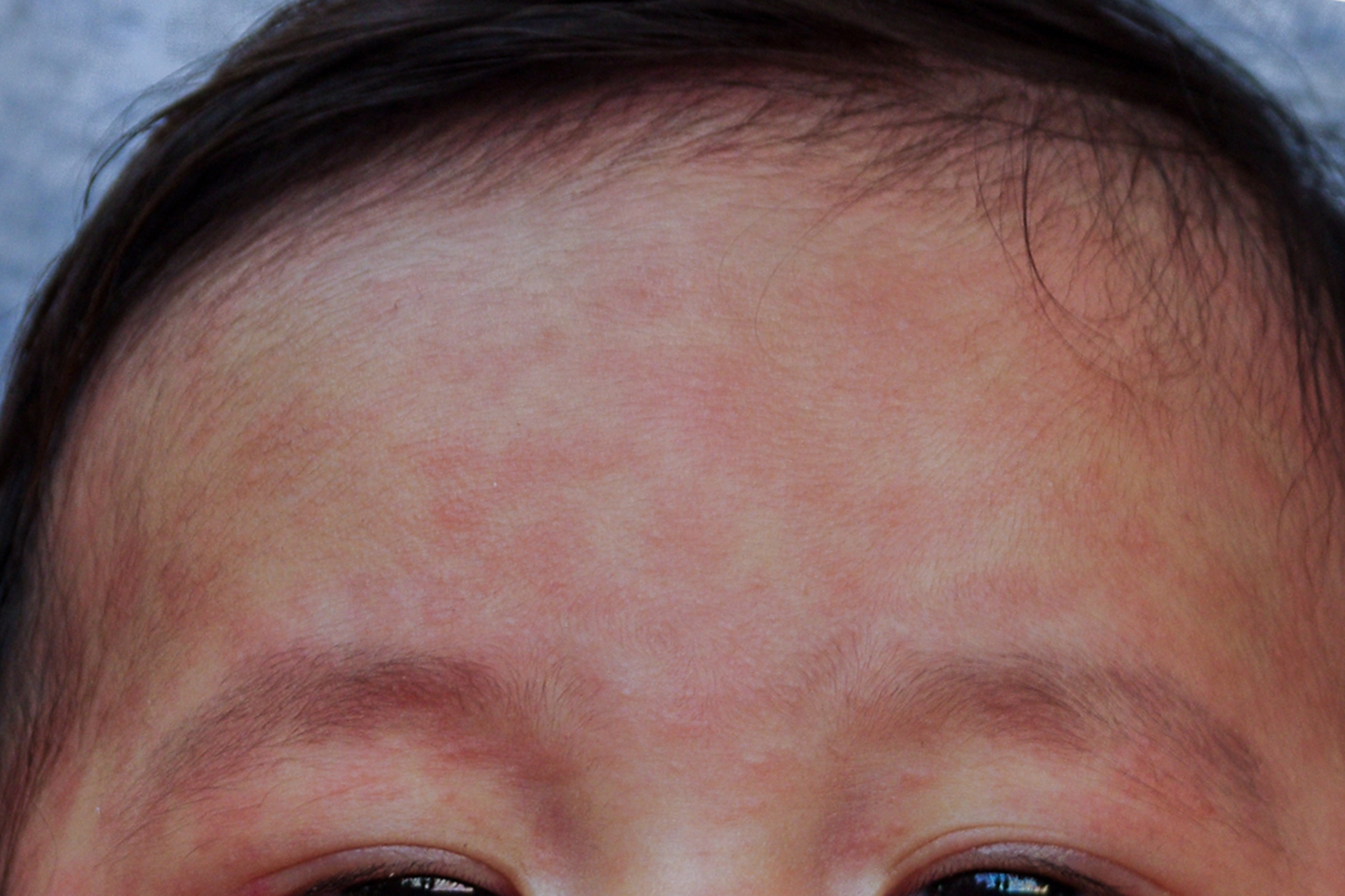 close up picture of rash on light brown skin, rash appears less bright and more brown, but still blotchy patches.